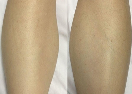 Laser Hair Removal Vs Waxing - After Image