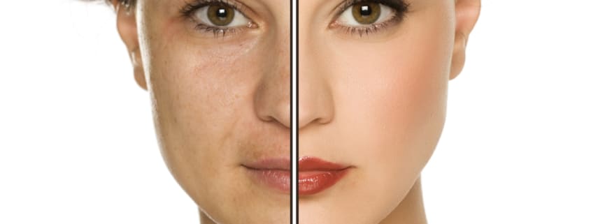 microdermabrasion pigmentation