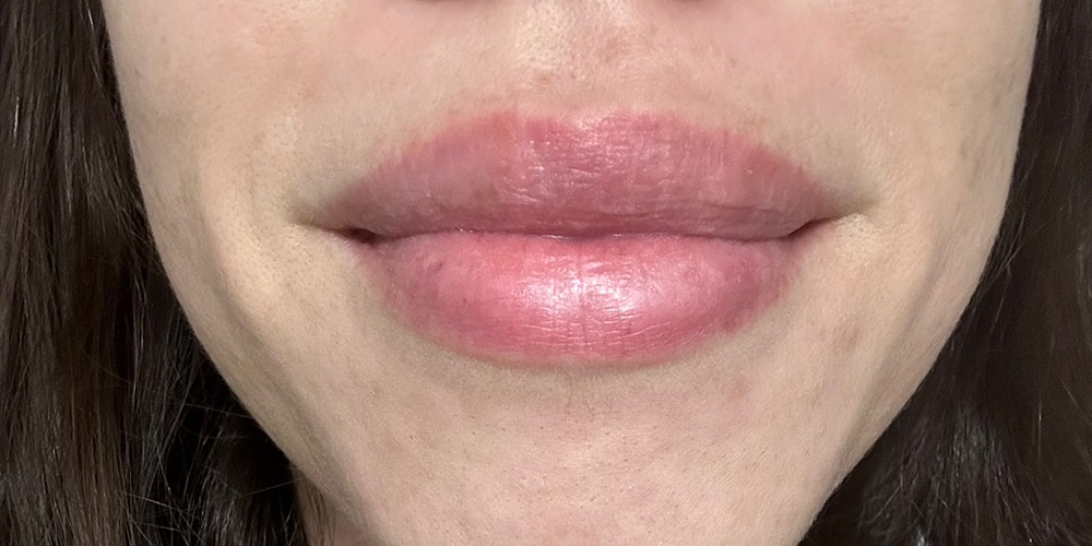 After Perioral Dermatitis