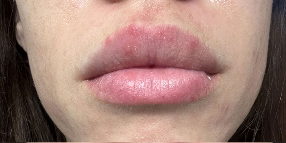 Before Perioral Dermatitis