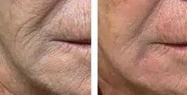 Dermal Roller Treatment