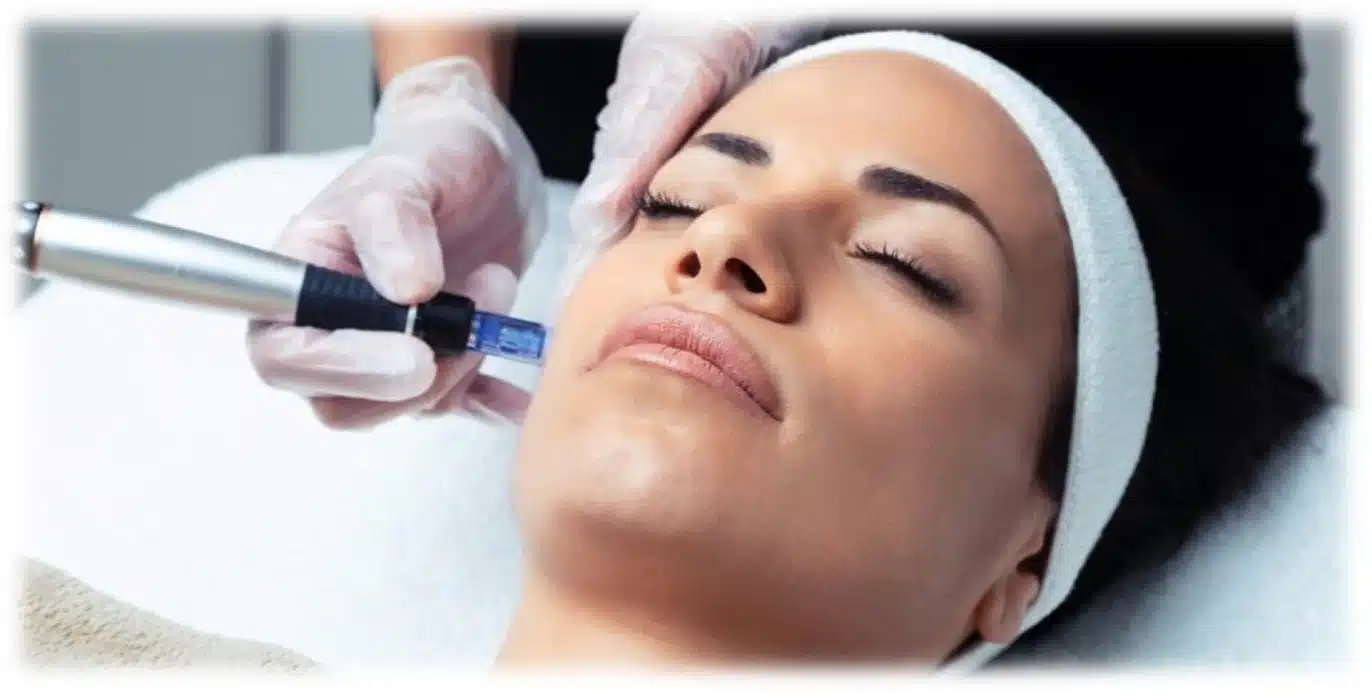 Microneedling