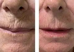 Microneedling Candidates