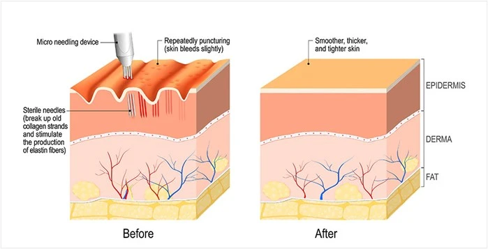 Microneedling Diagram