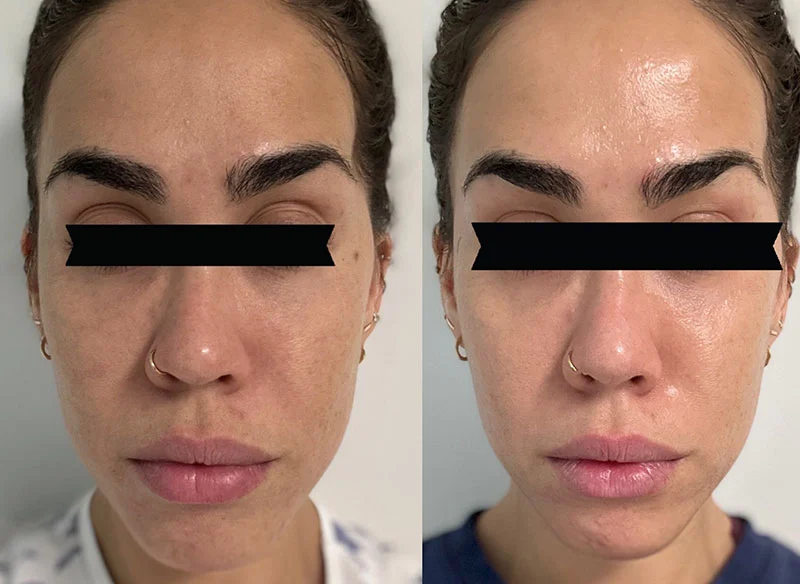 Before and After Microneedling with Purasomes