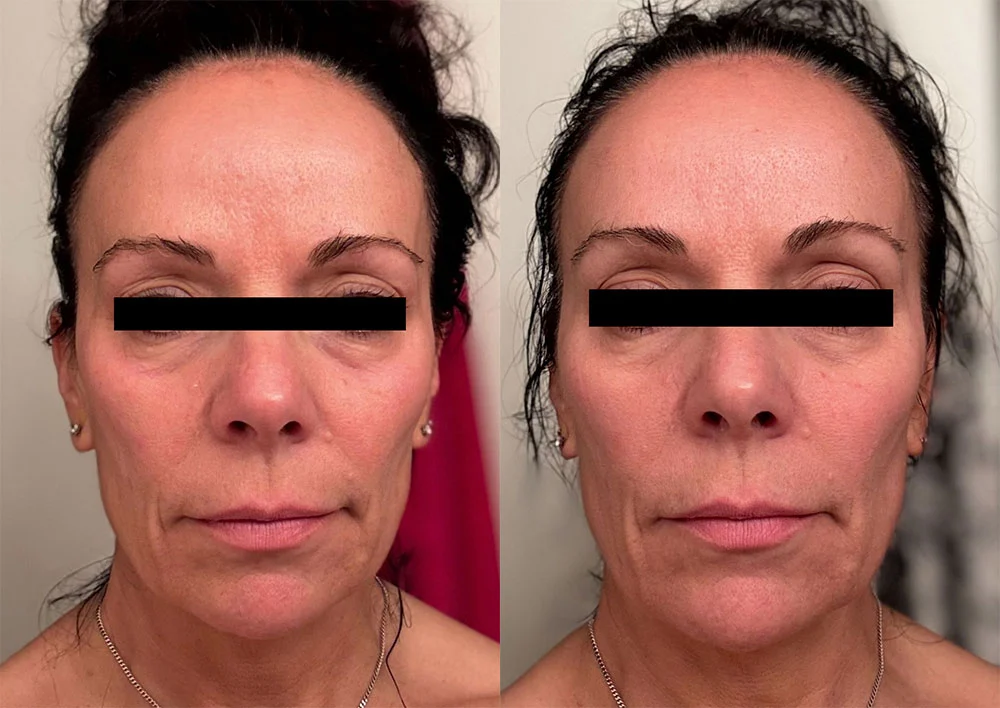 Before and Five Days After Microneedling with Purasomes