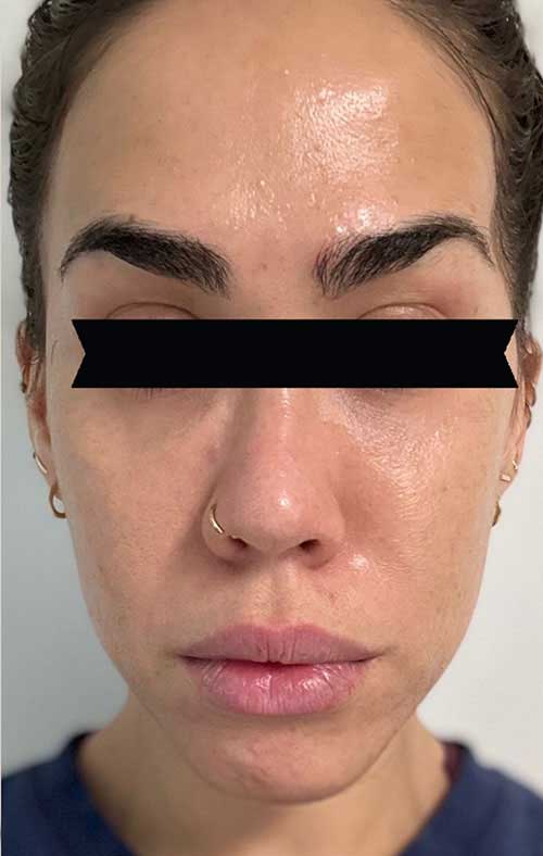 Five Days Post Microneedling with Purasomes/Exosomes