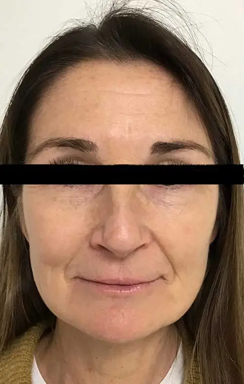 Five Days After Microneedling with Purasomes/Exosomes