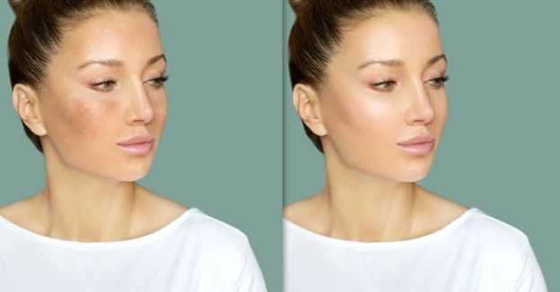 Before and after comparison of a woman's face showing the effects of sun damage and post-treatment results.