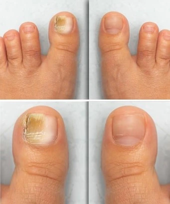 Before and after images showing the treatment of onychomycosis on toenails.