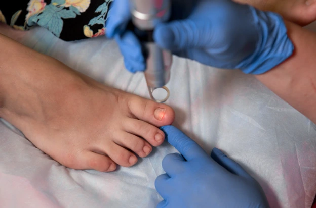 Laser therapy being applied to a toenail affected by onychomycosis.