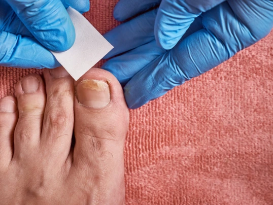 Application of a treatment patch to a toenail with onychomycosis by a professional wearing blue gloves.